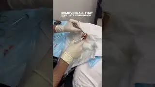 Satisfying Ingrown Hair Cyst Removals of 2024! 