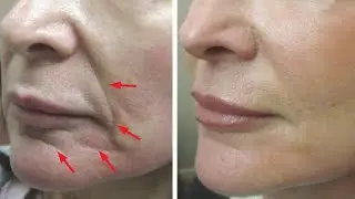 Just 2 skin tightening and face lifting home remedies