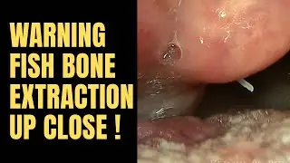 Warning : Fish Bone Extraction Up Close !