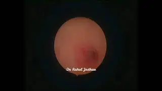 Tips for vaginoscopic entry in acutely retroverted uterus at hysteroscopy