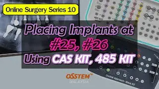 Placing Implants at #25, #26 Using CAS Kit, 485Kit