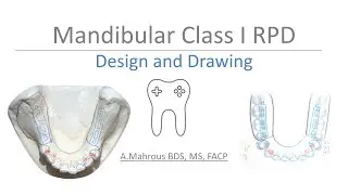 Mandibular Class I RPD Design: Step-by-Step Guide to Surveying & Drawing on Casts and Paper