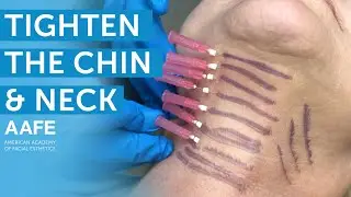 Smooth Threads Step Ladder Technique to tighten the Chin and Neck | AAFE
