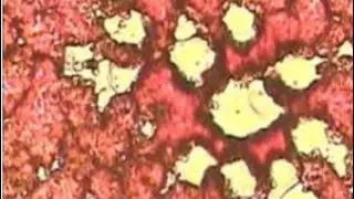 Liver Flukes - Live Blood Analysis Training Course
