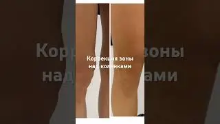 Коррекция зоны над коленками. СМАС-лифтинг. Результат на фото после - через 3 месяца.