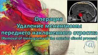 Операция. Удаление менингиомы клиновидной кости. Нейрохирургия. Neurosurgery. Brain tumor removal