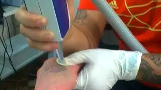как мне содили татуировки лазером. Не единого шрама не осталось !!!