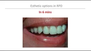 Esthetic Options for RPDs in 6 mins