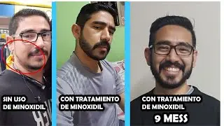 9 mes uso de minoxidil 5% kirkland