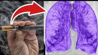 Man vapes for years and this happened to his lung #medical