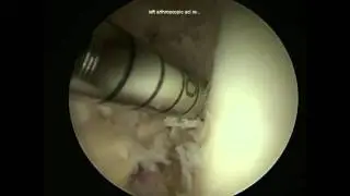Anatomic ACL Reconstruction