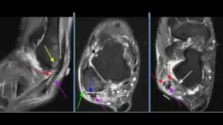 MRI Ankle Case 09