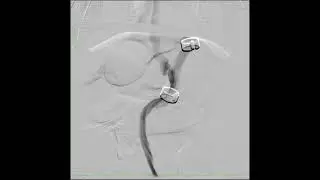 Myrical   LGA LGP double ameroid around all branches DSA angio