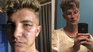My Bike Accident *Nasty Injuries*