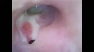 CSOM |atticoantral disease|