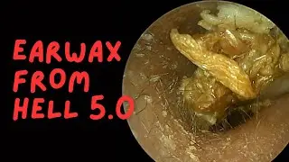 Earwax From HELL 5.0