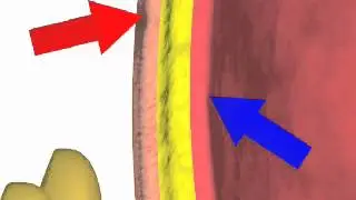 Paracentesis NEJM