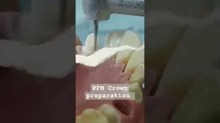 Reduction for canine #preparation #Reduction #dr_ghazal