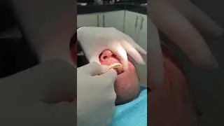 Caso de Implantes Dentales Don Alejandro 🦷 Fundación Implantes para Todos