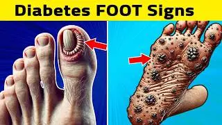 8 Signs Your Feet Tell You About Diabetes Complications!
