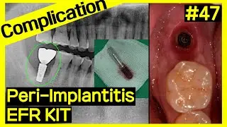 [Online Surgery] #47, Implant removal + GBR
