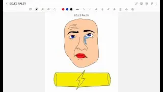 BELL'S PALSY