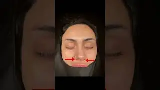 Third Revision Rhinoplasty
