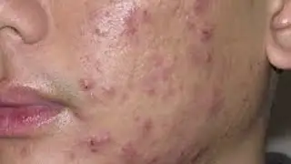 АНТИБИОТИКИ при акне и розацеа (лекция в хорошем качестве)