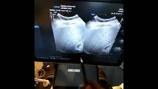 Cálculo por US de la Fracción Grasa en Hígado. PARTE 2.