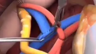 kidney transplant surgery/ Laparoscopic surgery/Kidney failure.