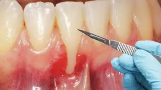 This Woman Had 3 Painful Gum Grafts... IT DIDN'T WORK