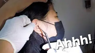 Cockroach Stuck in Woman's Ear Removed Piece by Piece