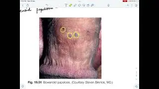 Pre-malignant lesions of Penis