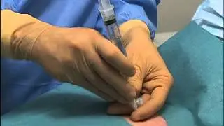 Needle Aspiration of Pneumothorax by the NEJM