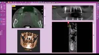 Dantų implantacija. Dantų atkūrimas ant implantų "Papadent" klinikoje.
