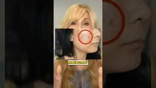 Best Melasma Treatment! This Peel Works 