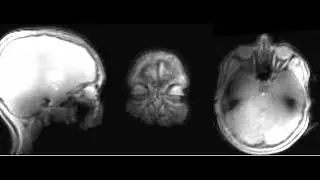 Dynamic imaging of eye via #PETALUTE at UHF 7T