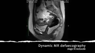 Prof. Sezai Leventoglu-Transperineal rectocele repair