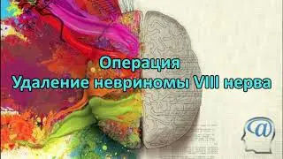Операция. Удаление невриномы преддверно-улиткового нерва. Нейрохирургия. Acoustic Neuroma Surgery