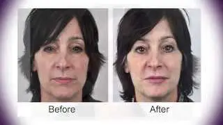 My Liquid Facelift - long version