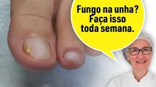 FUNGO NA UNHA: FAÇA ISSO EM CASA TODA SEMANA