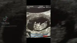 10 weeks already ❤️it’s  how baby looks like on ultrasound.It’s my beautiful baby- girl ❤️.