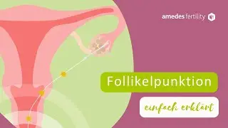 Follikelpunktion: Die Eizellentnahme in der Kinderwunschbehandlung einfach erklärt 👶💡