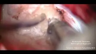 Delicot in an Acoustic Neuroma Resection, Retrosigmoid Approach Part 1