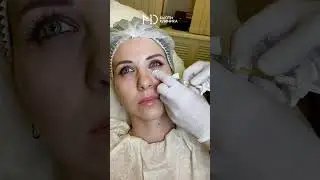 Контурная пластика носослезной борозды🤩 