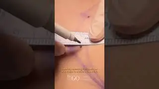 Achieving Natural Elegance with 300cc Round Breast Implants