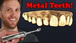 Casting my Teeth in Bronze!