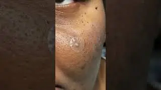 Pimple patch chronicles | acne meds Vol I | 