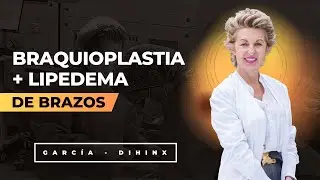 Braquioplastia + Lipedema de brazos | Dra. García-Dihinx
