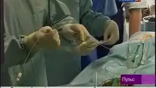 Цирроз печени  Внутрипеченочное шунтирование